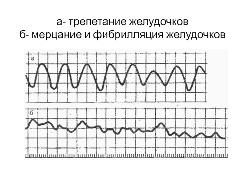 Как выглядит фибрилляция желудочков на мониторе