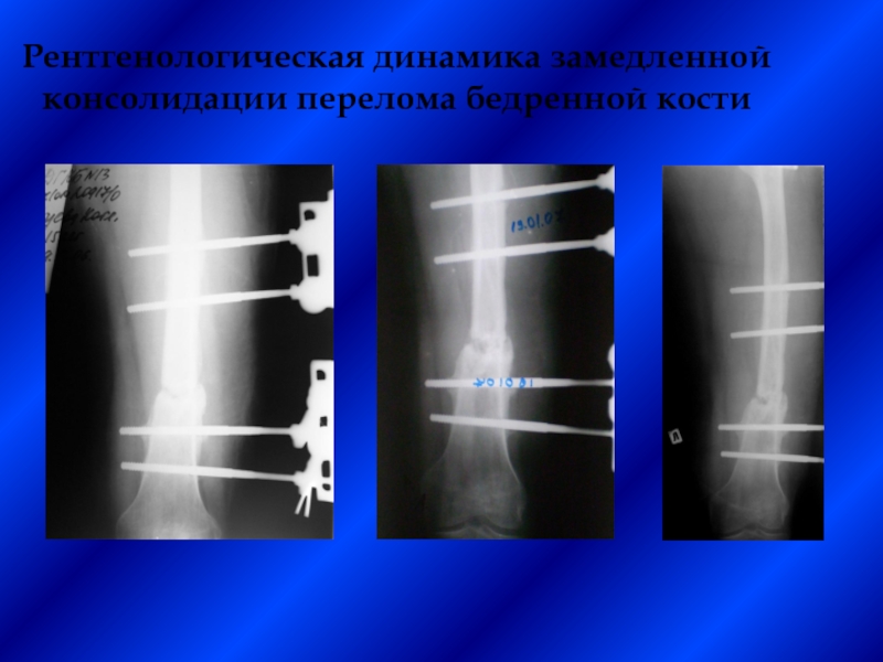 Замедленная консолидация презентация