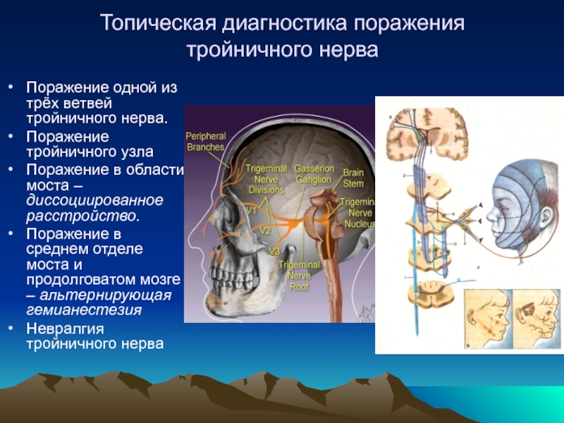 Диагностика нервов. Диагностика поражения тройничного нерва. Топический диагноз тройничный нерв. Невралгия тройничного нерва топический диагноз. Топическая диагностика.