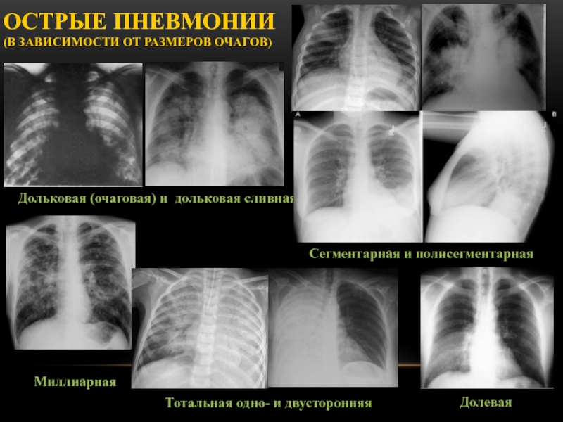 Двухсторонняя пневмония фото