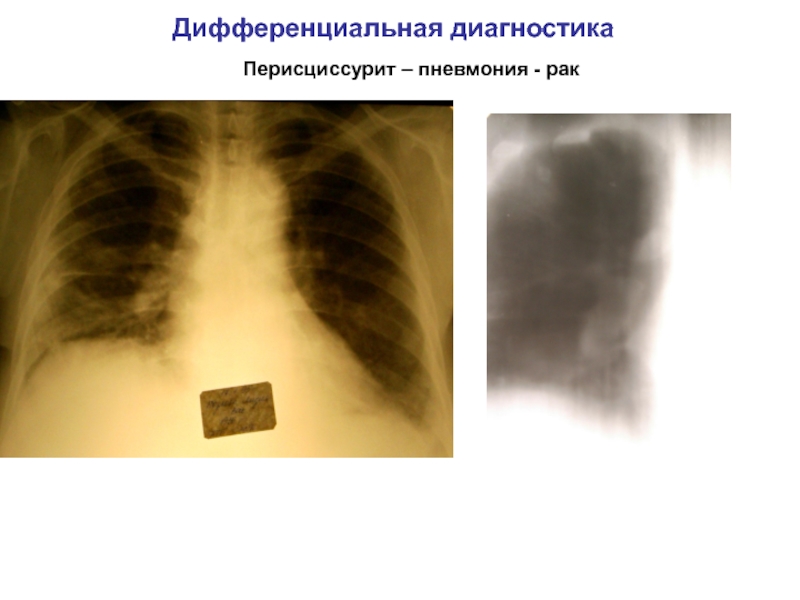 Перисциссурит рентген картина