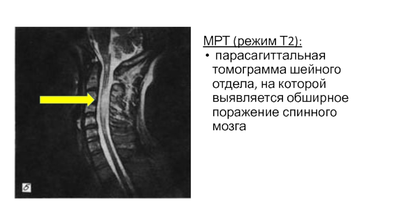 Острый рассеянный энцефаломиелит презентация