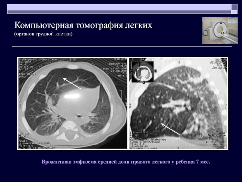 Компьютерная томография грудной клетки как подготовиться