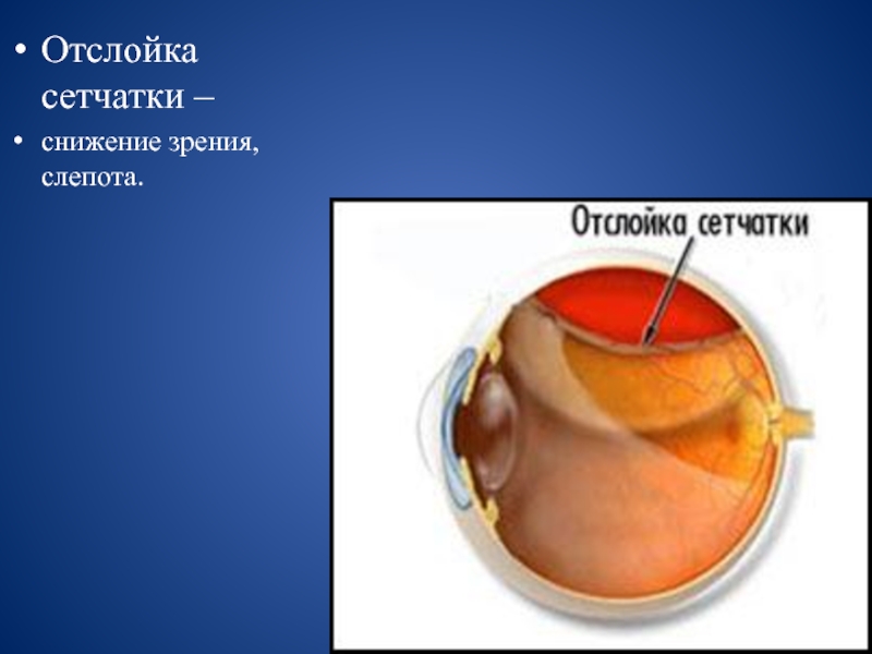 Отслойка сетчатки презентация