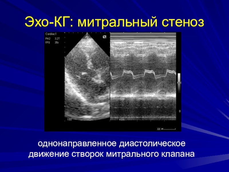 Вегетации на митральном клапане