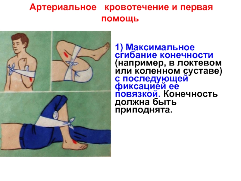 Артериальное  кровотечение и первая помощь1) Максимальное сгибание конечности (например, в локтевом или коленном суставе) с