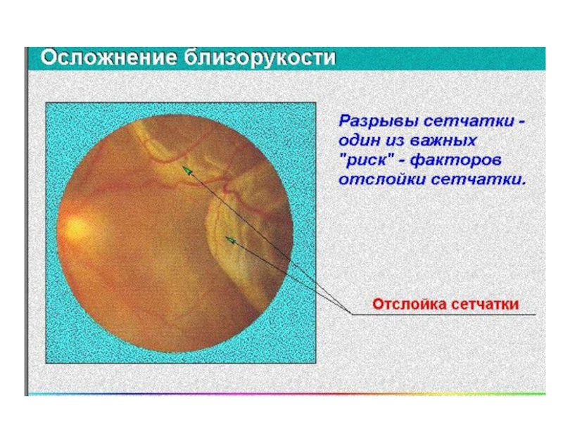 Презентация аномалии рефракции