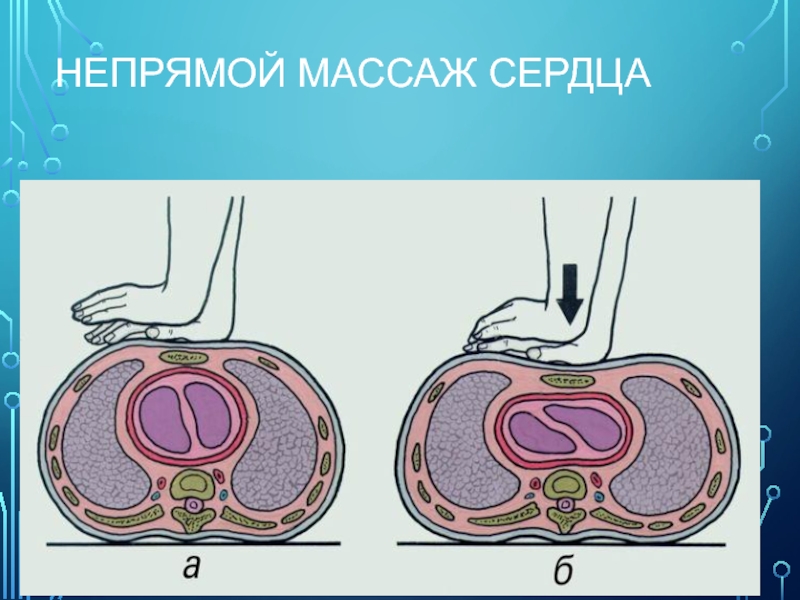 Непрямой массаж сердца схема