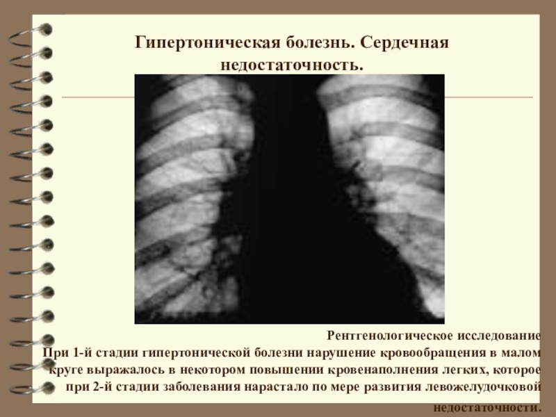 Гипертоническая болезнь карта смп