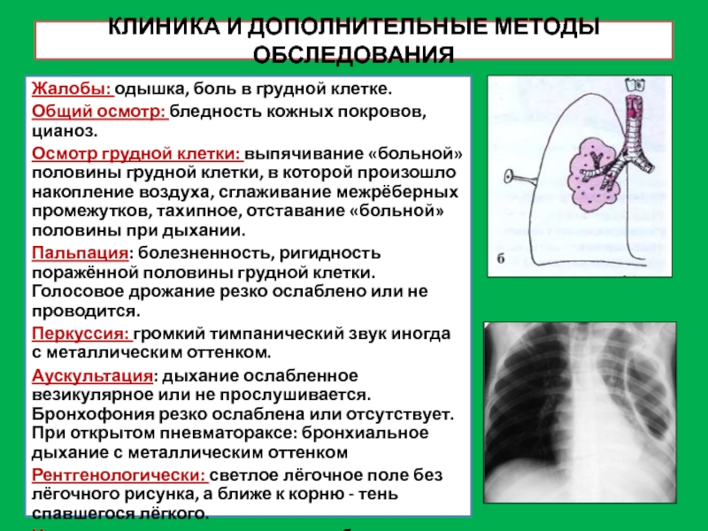 Гидроторакс легких карта вызова