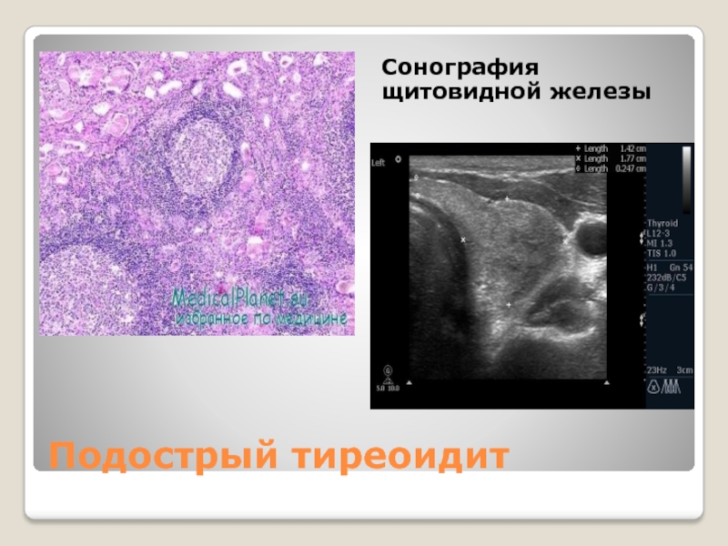 Щитовидная железа по типу тиреоидита. Подострый тиреоидит. Сонография щитовидной железы. Подострый тиреоидит на УЗИ. Подострый тиреоидит щитовидной железы.