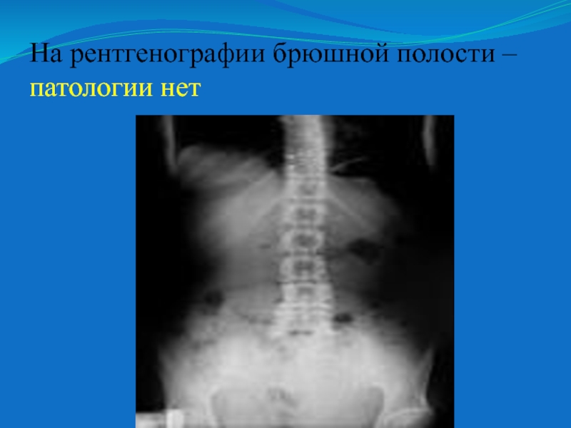 Рентген брюшной. Рентгенограмма брюшной полости норма. Рентген брюшной полости патологии. Опухоль в брюшной полости на рентгене. Рентген брюшной полости с описанием.