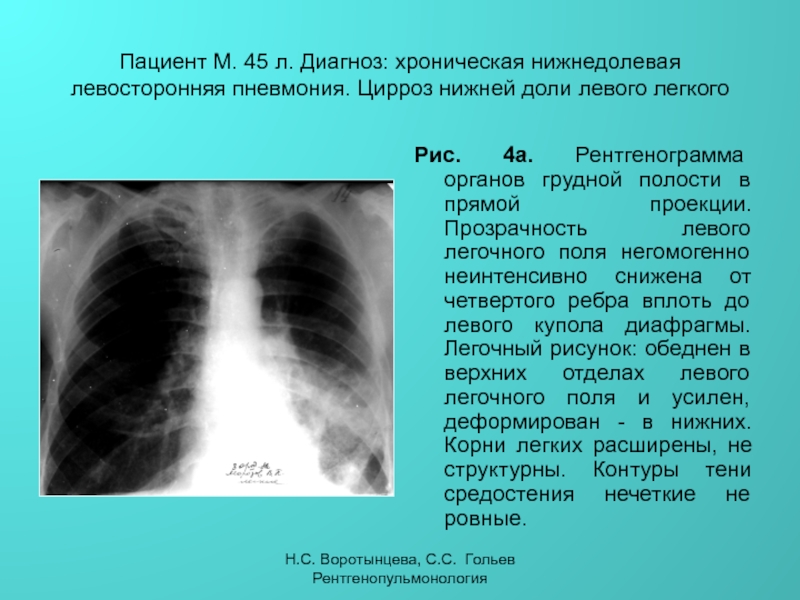 Прикорневое усиление легочного рисунка