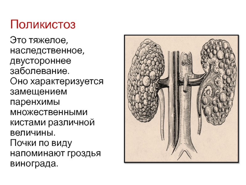 Паренхима почки. Поликистоз почек Тип наследования. Паренхима почек дифференцирована что это. Поликистоз почек анатомия. Паренхима это в медицине почки.