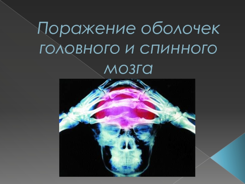 Презентация Поражение оболочек головного и спинного мозга