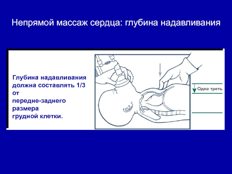 Непрямой массаж сердца глубина продавливания