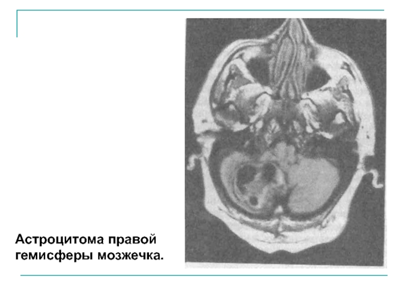Гемисферы мозжечка изменение. Пилоцитарная астроцитома. Астроцитома мозжечка мрт. Астроцитома червя мозжечка. Астроцитома мозжечка кт.