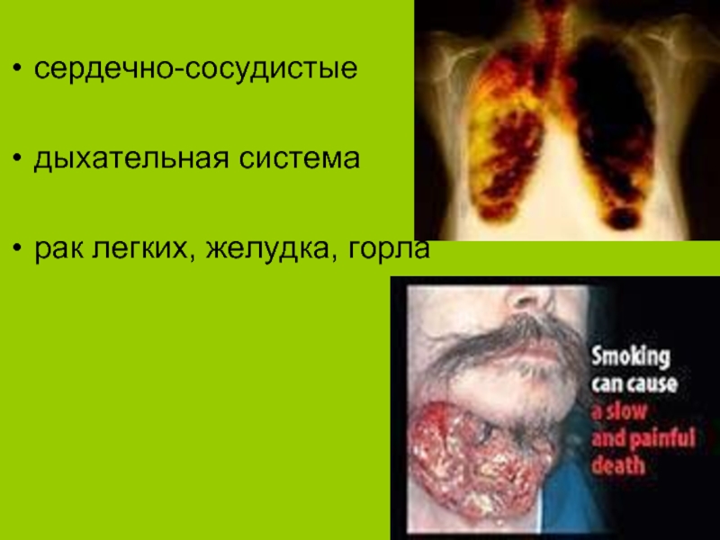 Заболевания курильщиковсердечно-сосудистые    дыхательная системарак легких, желудка, горла