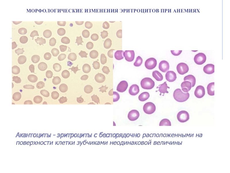 Морфологические изменения в эритроцитах рисунок