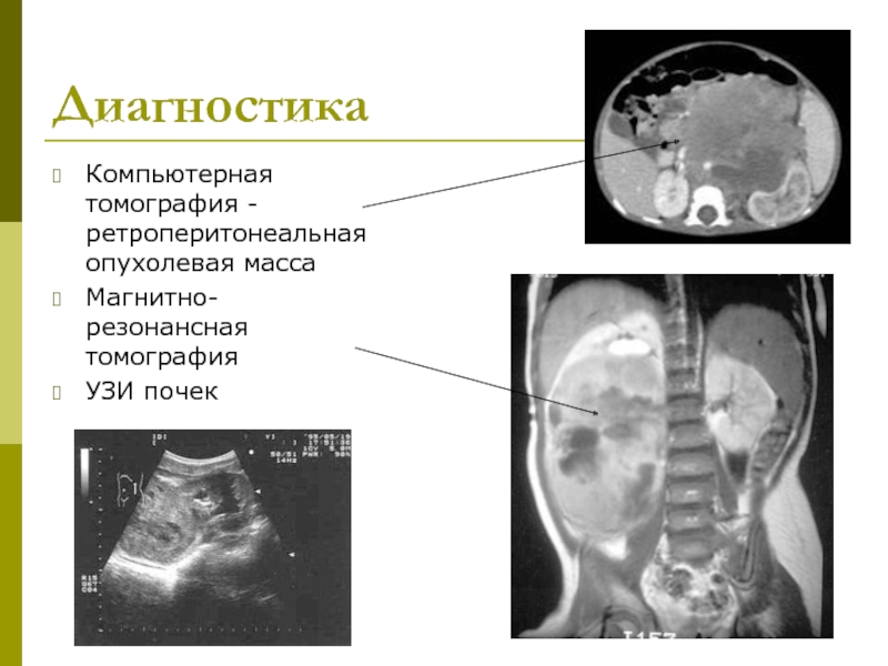 Нейробластома у детей презентация