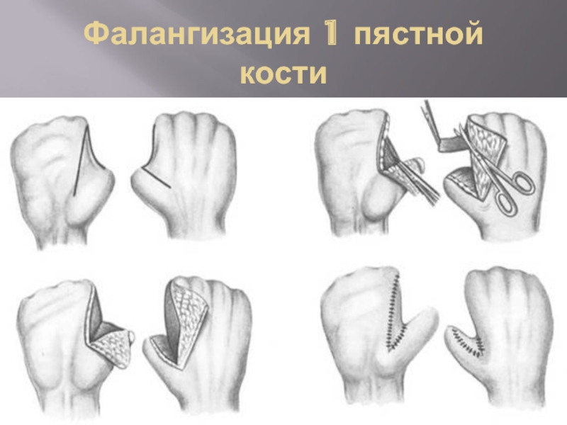 Первой пястной кости. Фалангизация 1 пястной кости по Альбрехту. Синостоз 1 пястной кости. Головка 5 пястной кости. Головка 4 пястной кости.