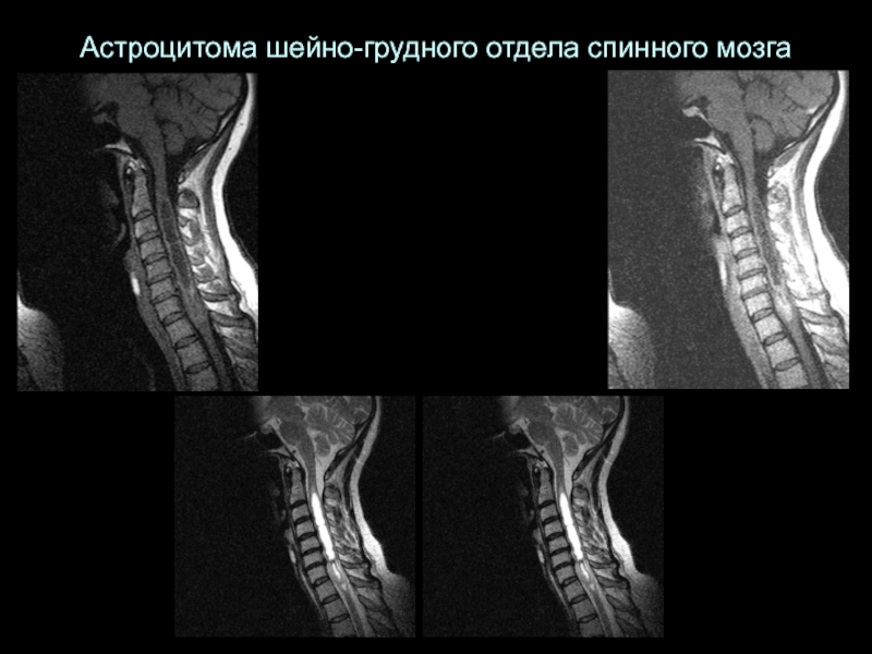 Опухоль спинного мозга