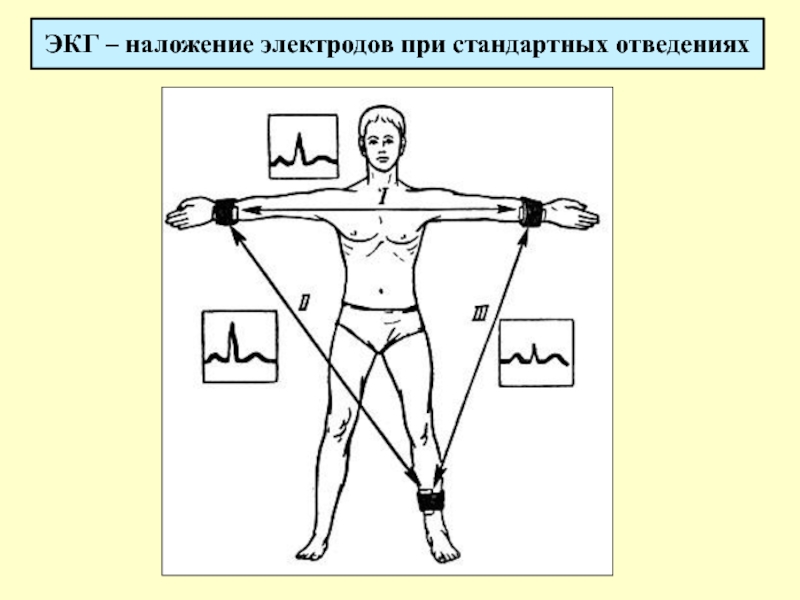 Картинка стандартные отведения