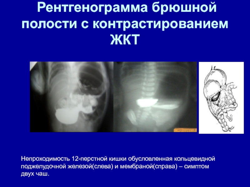 Рентгенография брюшной полости