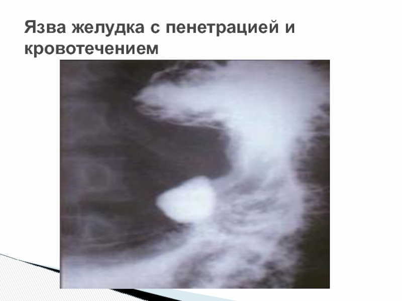 Язва на узи. Пенетрирующая язва желудка рентген. Пенетрирующая язва желудка и 12-перстной кишки. Перфорация язвы желудка рентген. Пенетрация двенадцатиперстной кишки.