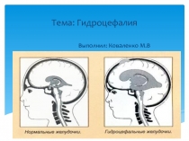 Тема: Гидроцефалия Выполнил: Коваленко М.В
