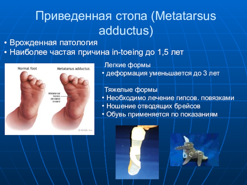 Приведенная стопа (Metatarsus adductus) Врожденная патология Наиболее частая причина in-toeing до 1,5 летЛегкие формы деформация уменьшается до