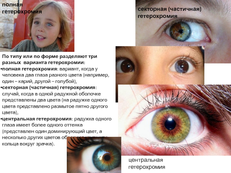 Как заболеть гетерохромией глаз в домашних условиях