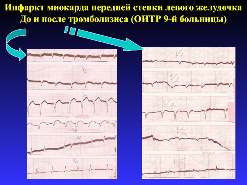 Изменение передней стенки левого желудочка. Острый инфаркт миокарда передней стенки. Инфаркт миокарда передней стенки левого желудочка. Трансмуральный инфаркт передней стенки. Инфаркт миокарда нижней стенки.
