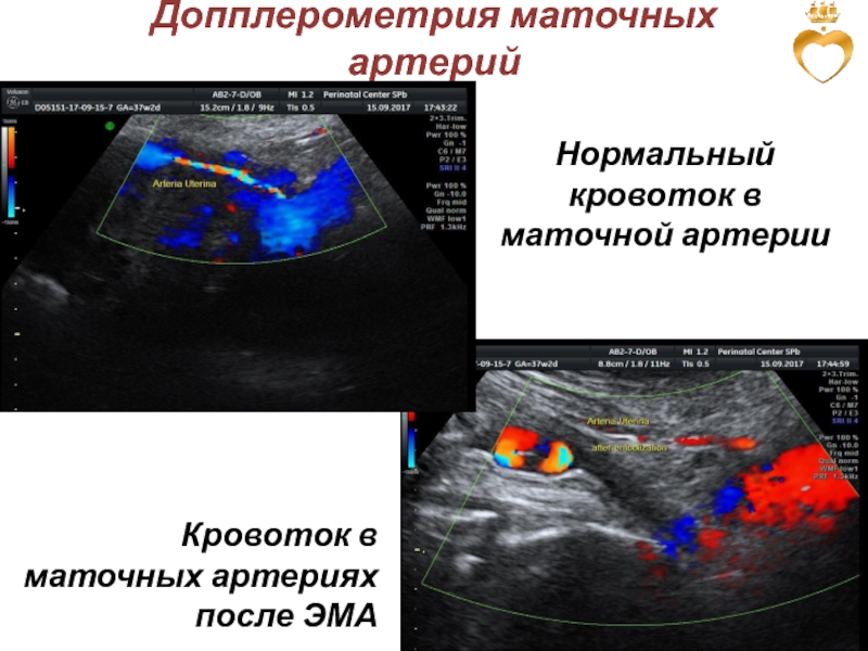 Допплерометрия маточных артерий. Маточная артерия на УЗИ. Маточная гемодинамика