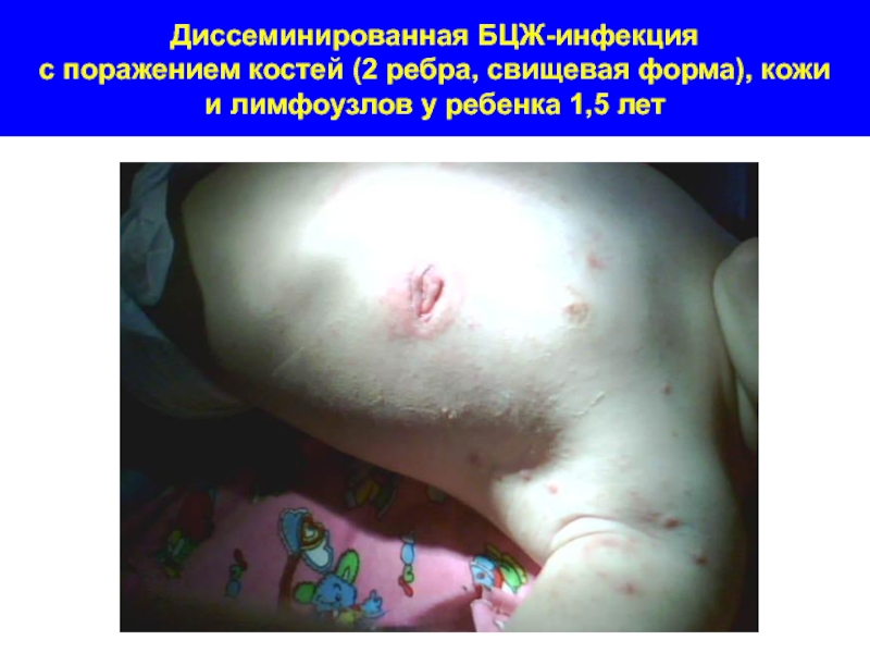 Диссеминированная БЦЖ-инфекция  с поражением костей (2 ребра, свищевая форма), кожи и лимфоузлов у ребенка 1,5 лет