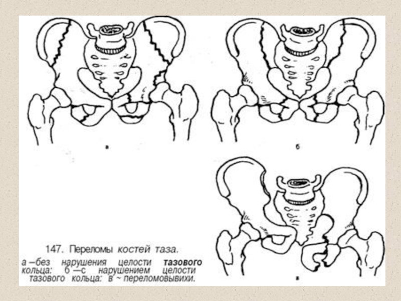Перелом костей таза. Переломы костей таза классификация. Перелом костей таза классификация рентген. Классификация переломов подвздошной кости. Перелом лонной кости классификация.