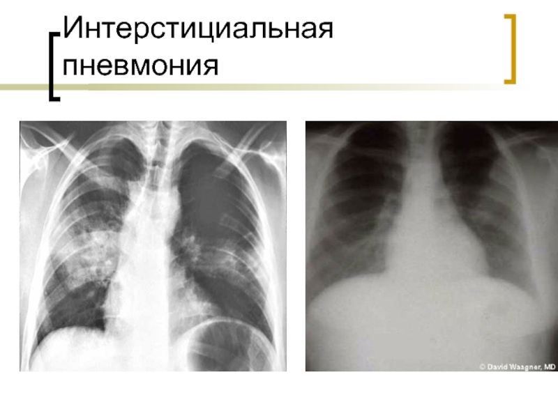 Хламидийная пневмония рентгенологическая картина - 85 фото