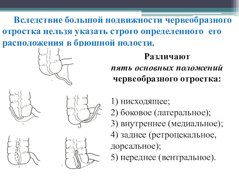 При ретроцекальном расположении червеобразного отростка характеристикой клинической картины является