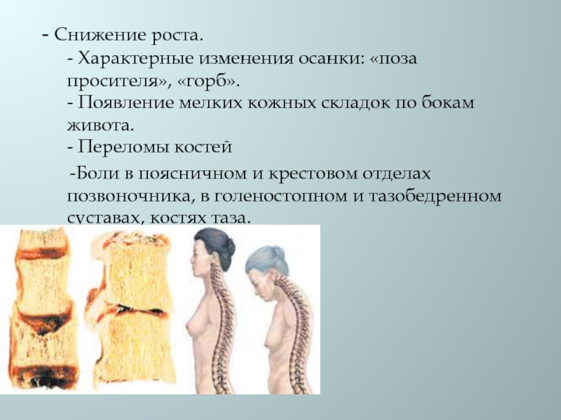 Рост характерен. Остеопороз осанка. Изменение осанки. Остеопоротический перелом позвоночника - изменение осанки. Изменения осанки при первичном остеопорозе.