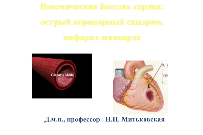 Ишемическая болезнь сердца:
острый коронарный синдром,
инфаркт миокарда
Д.м.н.,