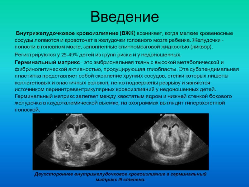 Ультразвуковая диагностика внутрижелудочковых кровоизлияний у детей Введение Внутрижелудочковое кровоизлияние (ВЖК) возникает, когда мелкие кровеносные сосуды лопаются и Введение Внутрижелудочковое кровоизлияние (ВЖК) возникает, когда мелкие кровеносные сосуды лопаются и кровоточат в желудочки головного мозга ребенка.