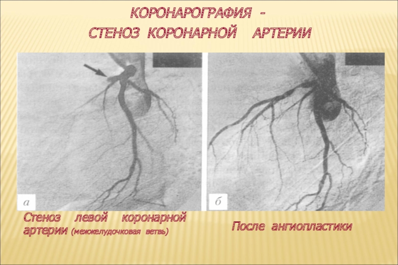 Сужение правой артерии. Коронарография сердца стеноз. Стеноз левой коронарной артерии. Коронарография стеноз ствола. Коронарография стеноз ПМЖВ.