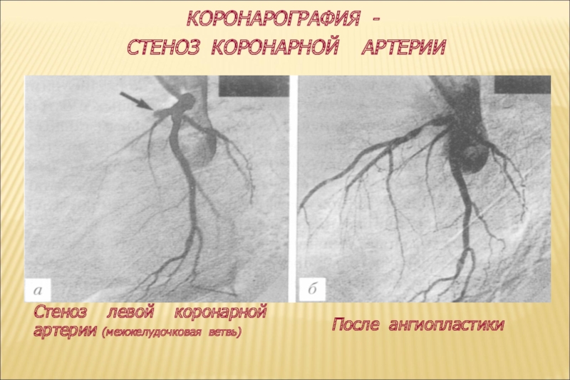 Исследование артерий. Коронароангиография стеноз. Коронарные артерии стеноз коронарография. Стеноз коронарной артерии ангиография. Стеноз левой коронарной артерии.