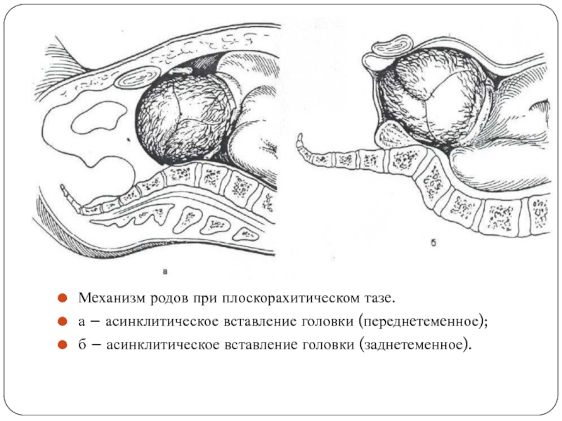 Механизм родов при плоскорахитическом тазе.а – асинклитическое вставление головки (переднетеменное);б – асинклитическое вставление головки (заднетеменное).