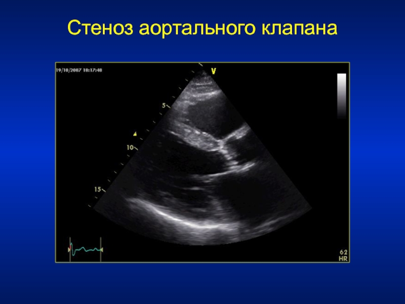 Аортальный клапан на эхокг