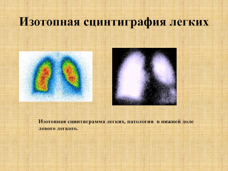 Сцинтиграмма является изображением