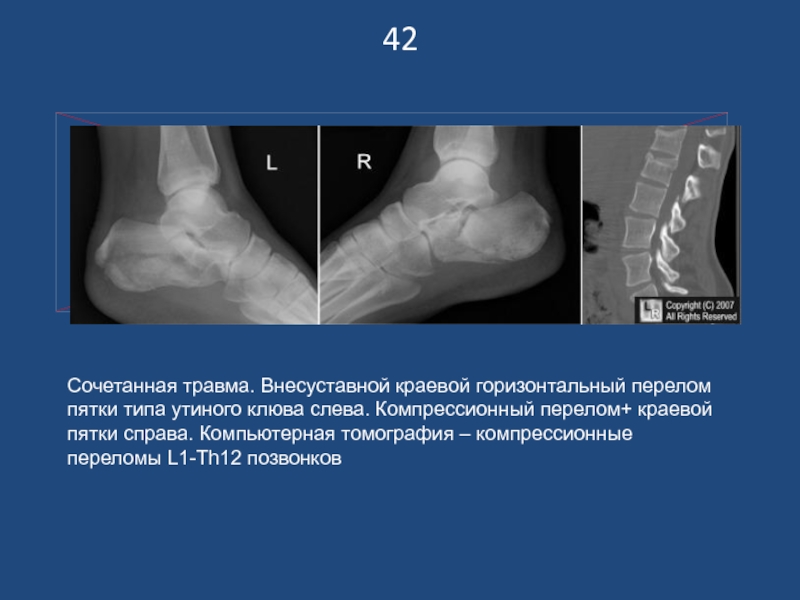 Перелом пяточной кости карта вызова