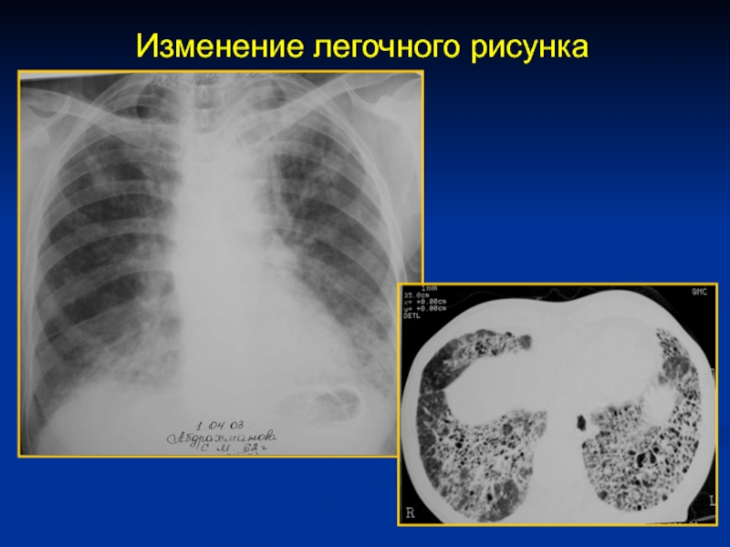 Усиление бронхолегочного рисунка на рентгене что это