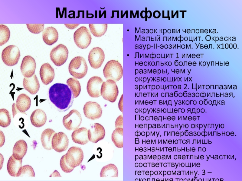 Реактивные лимфоциты в крови. Мазок крови человека окраска Азур 2 эозином. Кровь человека. Мазок крови. Окраска - Азур-эозин.. Окраска Азур-эозином эритроциты. Мазок крови окраска эозином.