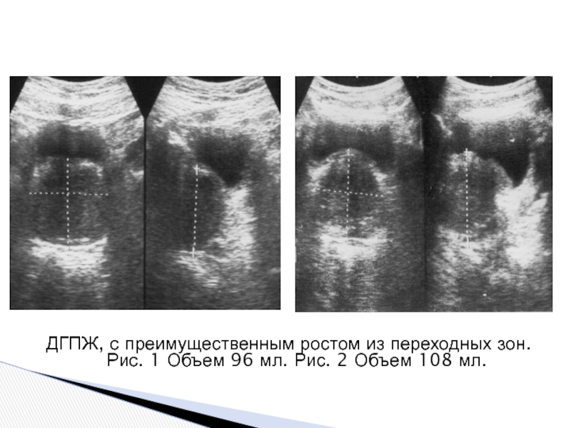 Гиперплазия предстательной железы 1. Аденома предстательной железы на УЗИ. УЗИ предстательной железы трансабдоминально. Зоны предстательной железы на УЗИ.